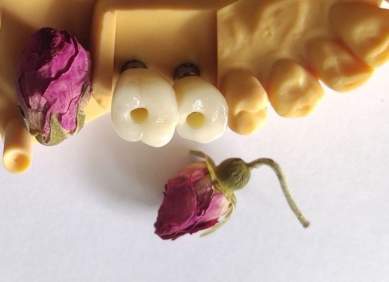 ครอบฟันครอบฟันเทียมซีเมนต์
