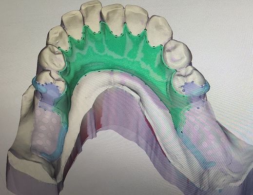 กรอบโลหะฟันปลอมบางส่วนที่ถอดออกได้ 3D