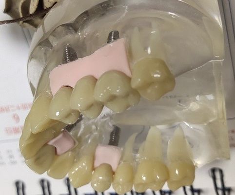 PMMA Provisional Crown ที่เข้ากันได้ทางชีวภาพ 100 เปอร์เซ็นต์