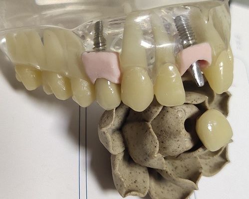 การกัดโลหะเปล่า PFM Inner Crown Dental 3D Print