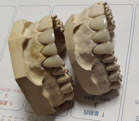 พอร์ซเลน CAD CAM PFM Crown