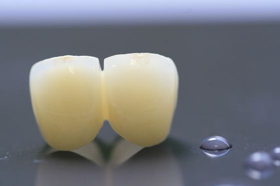 กรอบงานพิมพ์ 3 มิติ PFM Dental Lab Crown สำหรับทันตกรรม